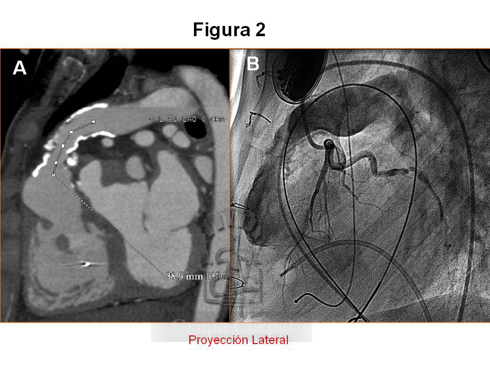 Imágenes TAC (A) y la angiografía basal en arteria pulmonar junto a la coronariografía (B)