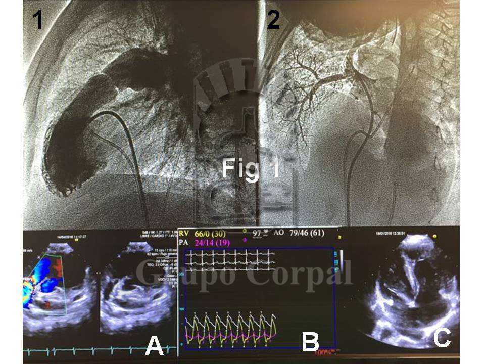 Imagen mes de enero 2019, Paciente con Estenosis Valvular Pulmonar y Comunicación Interauricular tratado con Valvuloplastia, figura 1