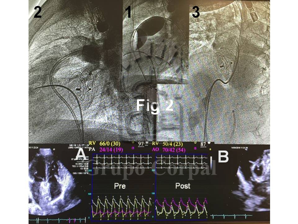 Imagen mes de enero 2019, Paciente con Estenosis Valvular Pulmonar y Comunicación Interauricular tratado con Valvuloplastia, figura 2