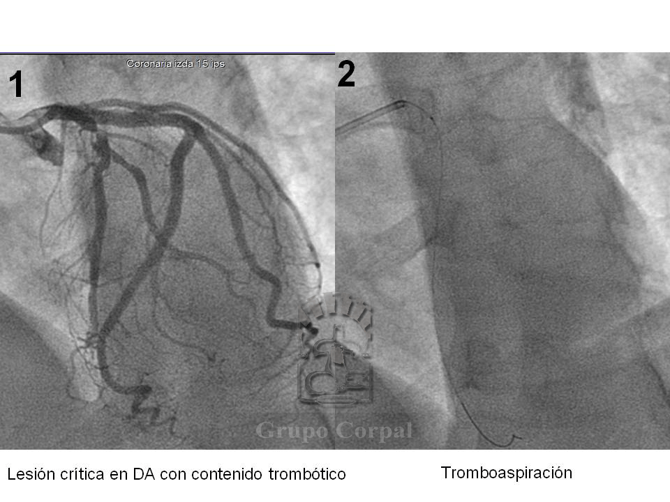 Imagen mes de marzo 2019. Paciente con síndrome coronario agudo por lesión crítica en Descendente Anterior 