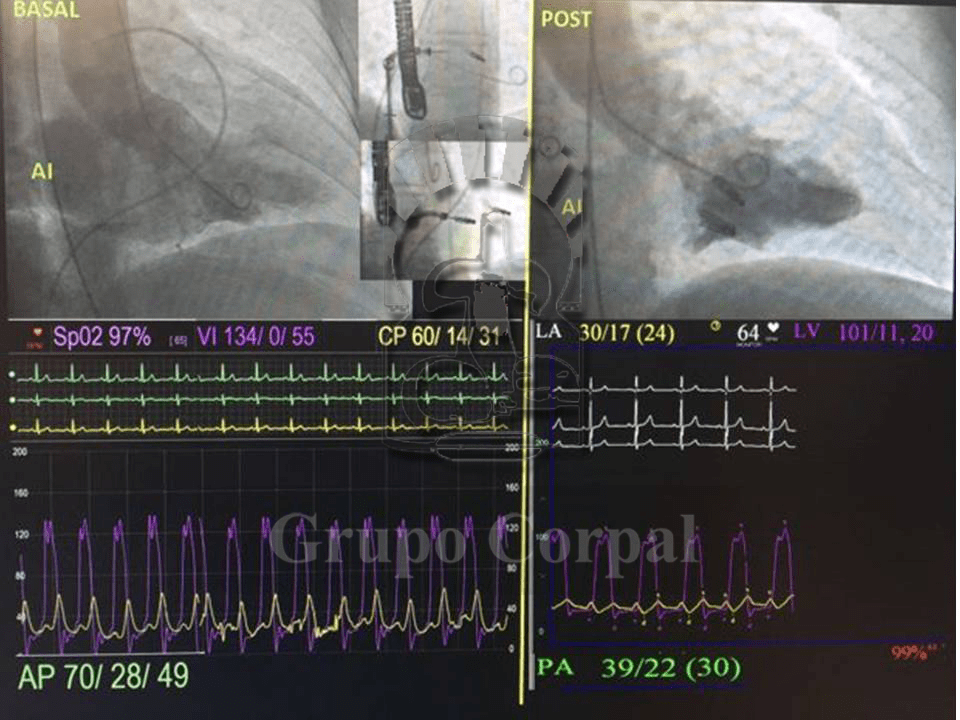 Imagen del mes de mayo 2019: Implante de 2 Mitraclips en una paciente de 73 años de edad con Insuficiencia Mitral severa orgánica, por prolapso de valva posterior en el Hospital Cruz Roja de Córdoba.