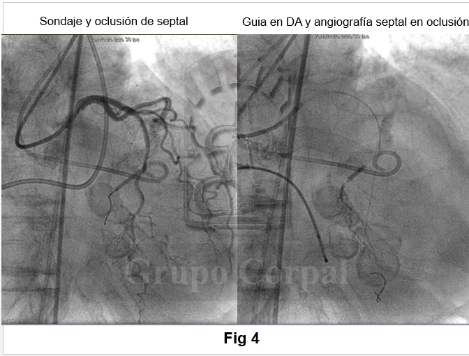 Se muestra el sondaje y oclusión de la rama septal así como una angiografía de la misma en oclusión.