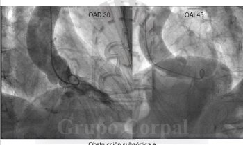 Miocardiopatía Hipertrófica Obstructiva tratada con Ablación Septral