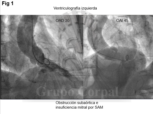2 ventriculografías izquierdas en distintas proyecciones. Se observa una gran hipertrofia con gran protrusión sistólica del septo en el tracto de salida junto a insuficiencia mitral por SAM.