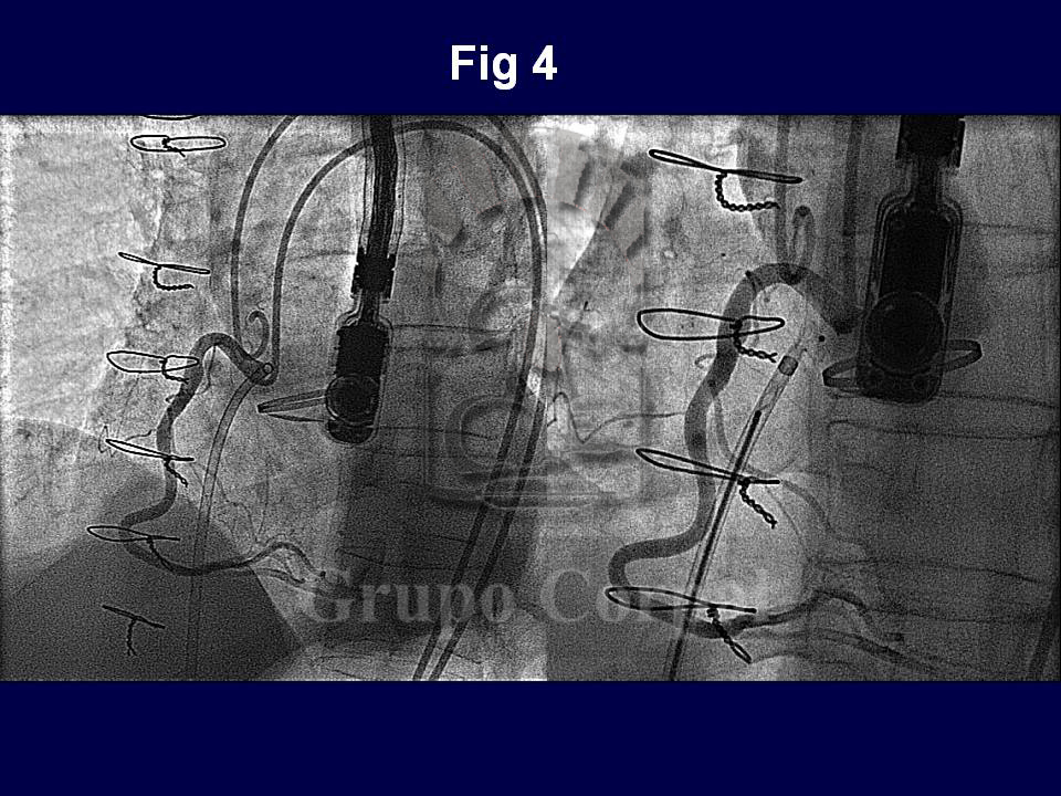 A través de la cánula se introdujo un dispositivo de Amplatz de CIV (6 mm) cuya cintura bloqueó la fístula (Figura 4), siendo exteriorizado su disco ventricular
