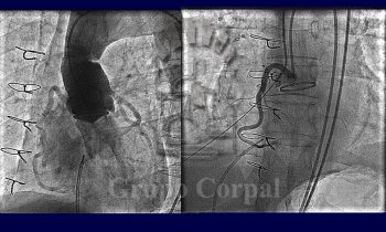 Fístula post-quirúrgica entre seno de Valsalva y ventrículo derecho