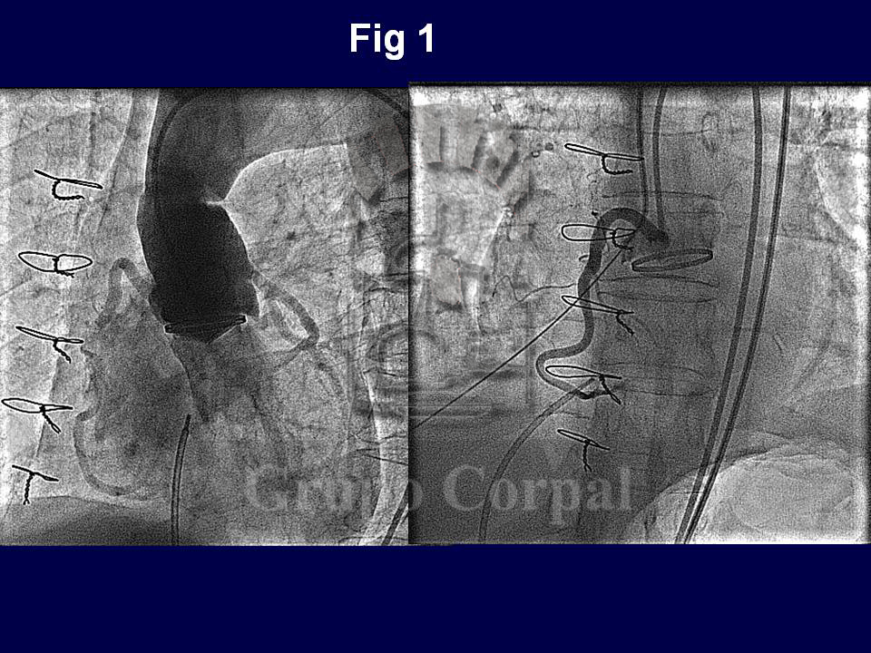 Imagen mes de junio 2019, Aortografía que mostraba el paso de contraste de aorta al ventrículo derecho 