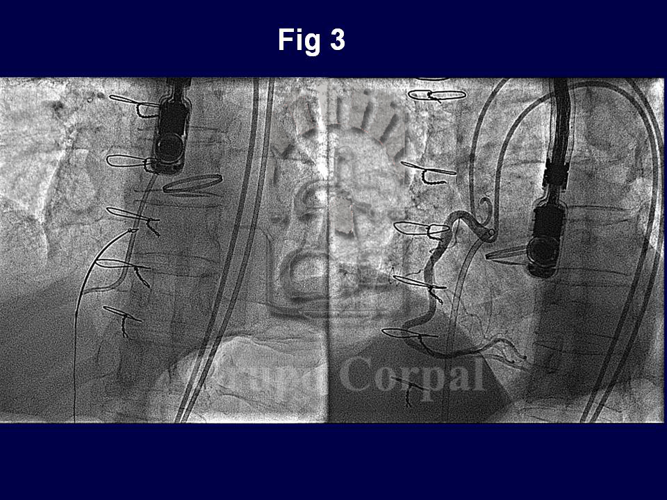 Avance del catéter hasta ventrículo derecho siendo capturado con un lazo desde el lado derecho 