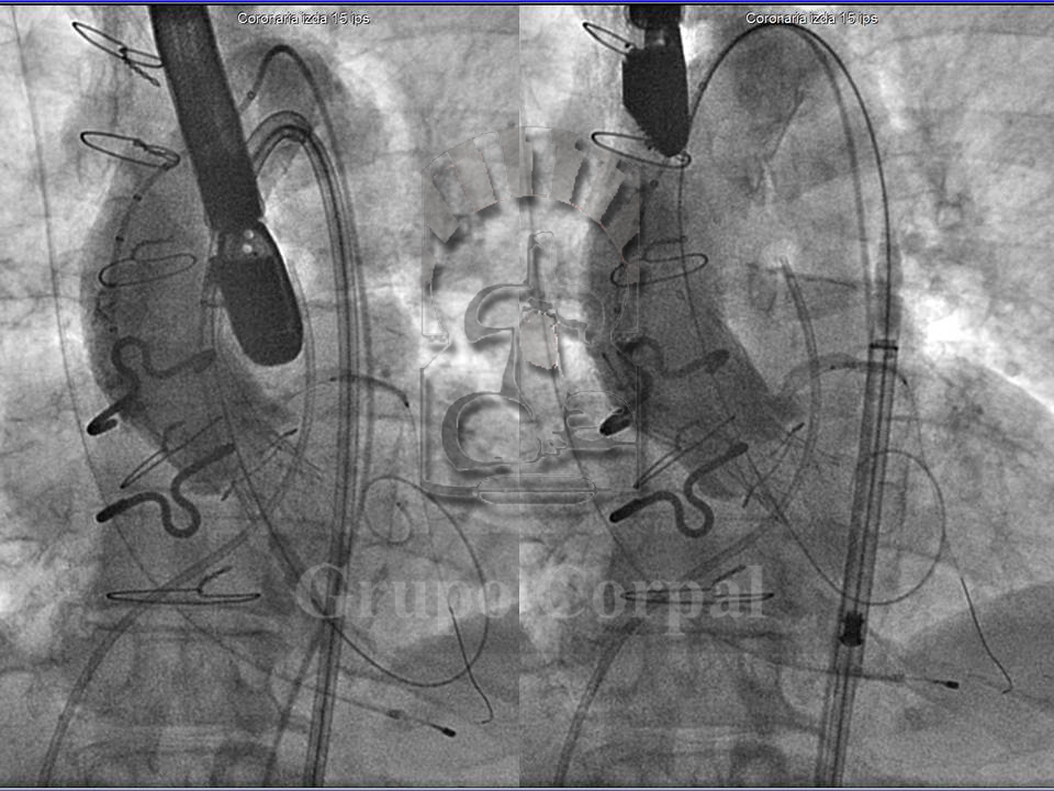 Aortografías en fase intermedia (A) y final (B) de la suelta, con el catéter transportador ya retirado a aorta descendente.