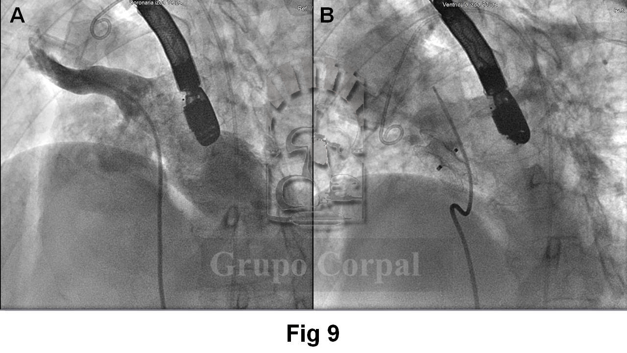 Resultado angiográfico  con imagen antes del tratamiento (A) y después de la suelta (B)