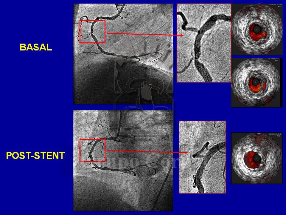 Imagen mes de agosto 2019, placa coronaria complicada que origina un infarto sin elevación del segmento ST en paciente que acude a urgencias
