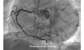 Paciente con angina inestable