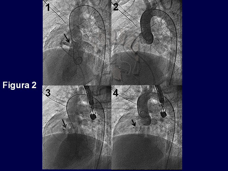 Imágenes angiográficas antes (1 y 2) y después (3 y 4) del cierre.
