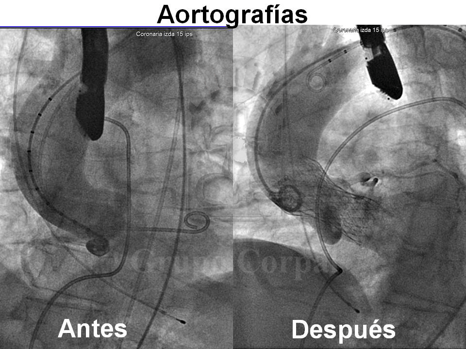 Aortografía antes y despues del implante de válvula CoreValve