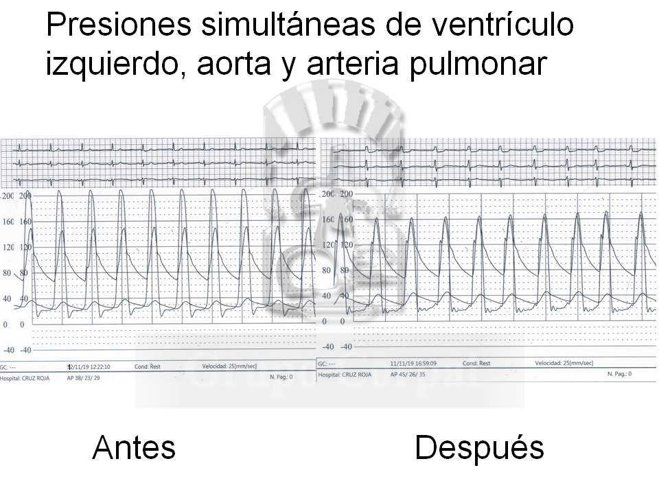 Presiones simultáneas ventrículo izquierdo  aorta y arteria pulmonar