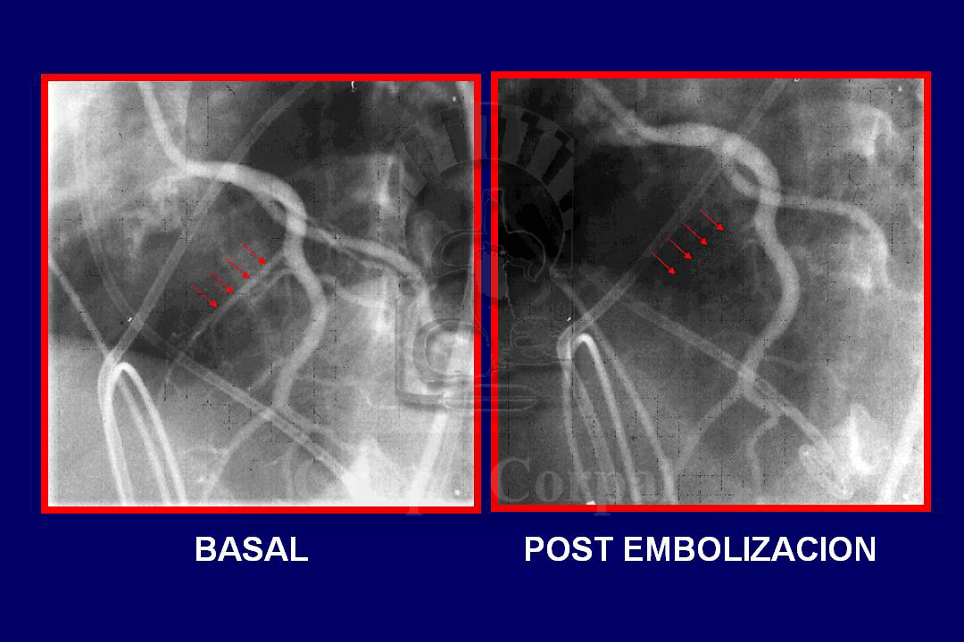 La imagen angiográfica muestra la coronariografía izquierda en proyección OAI-Craneal antes y después del tratamiento