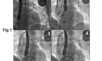 Implante de Mitraclip en paciente con insuficiencia mitral post-infarto de miocardio