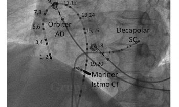 Ablación del Istmo Cavo