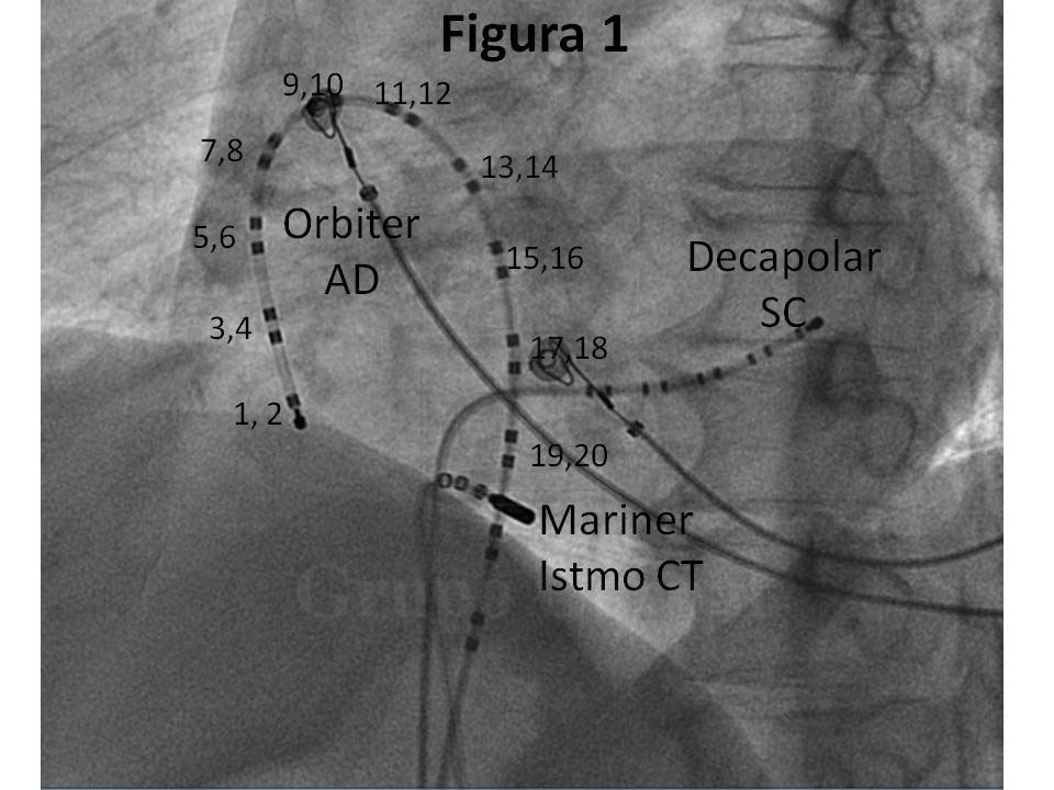 Imagen mes de febrero 2020, Ablación del Istmo Cavo-Tricuspídeo en un paciente con Flutter Auricular