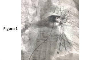 Aspiración trombótica en el Embolismo Pulmonar Agudo
