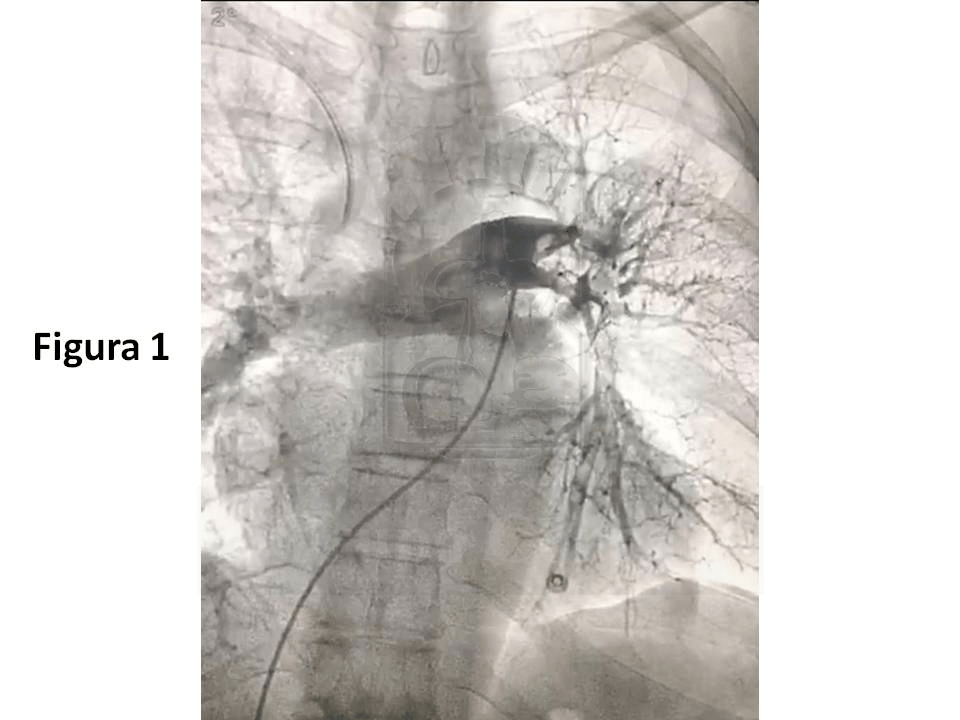 práctica oclusión trombótica de la arteria pulmonar izquierda, con un gran defecto intraluminal en su origen y sus ramas
