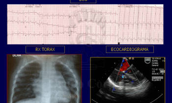 Cierre de 2 defectos (CIV y CIA) en un paciente en el mismo procedimiento