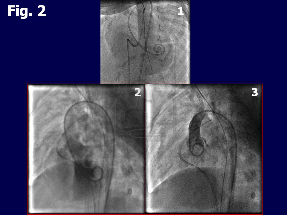 Figura 2: Imágenes angiográficas de estudio. 1: Catéteres en posición en ventrículo izquierdo y arteria pulmonar. 2: Ventriculografía izquierda en proyección  OAI 70/ cráneo 20, donde se aprecia el defecto subaórtico. 3: Aortografía en proyección OAI.