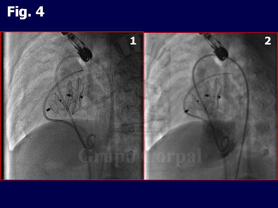 Figura 4: Imágenes radiológicas tras ambos implantes. 1: En proyección OAI, se puede ver los distintos planos de ambos septos ocluidos con los dispositivos. 2: Ventriculografía izquierda que muestra el cierre de la CIV.