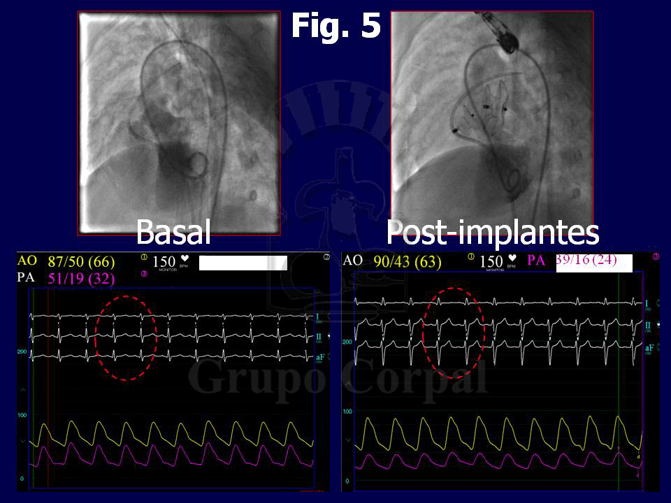 Imagen radiológica y ecográfica de ambos dispositivos implantados.