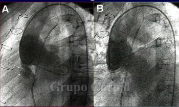 Fístula post-quirúrgica entre seno de Valsalva y el ventrículo derecho