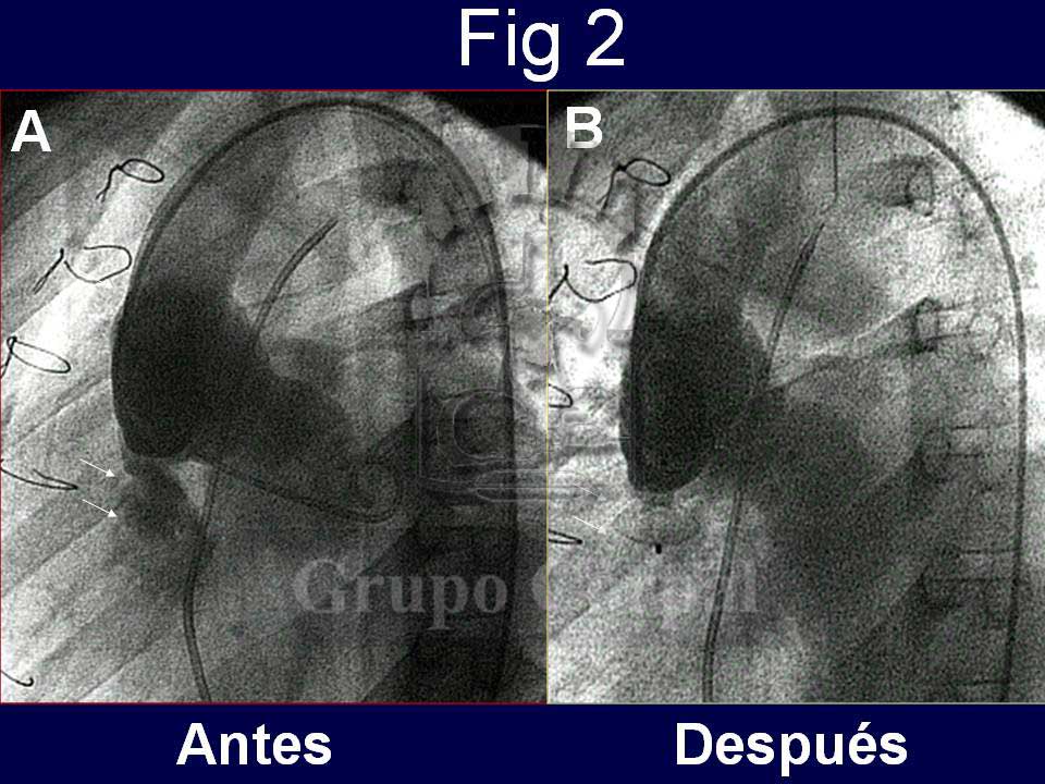 fístula post-quirúrgica entre seno de Valsalva aórtico y el ventrículo derecho en un paciente operado de Tetralogía de Fallot