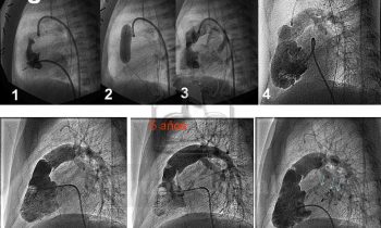 Atresia Pulmonar con Septo Integro
