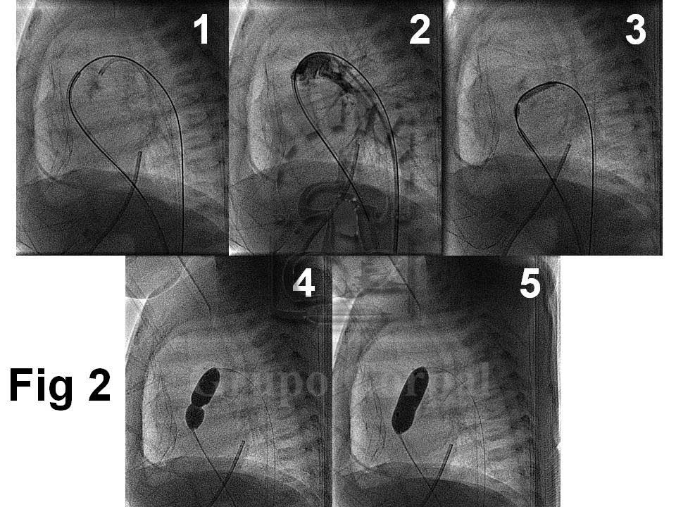 Pasos del procedimiento percutáneo de apertura y dilatación con catéteres balón progresivos de la membrana atrética, siempre en proyección lateral