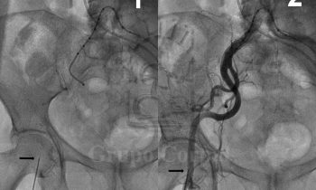 Implante de Válvula Aórtica percutánea (CoreValve)