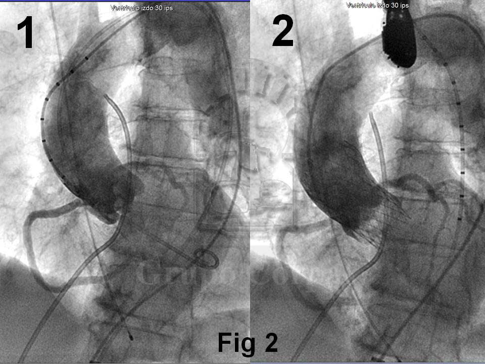 Aortografía antes y después del implante del stent valvulado 