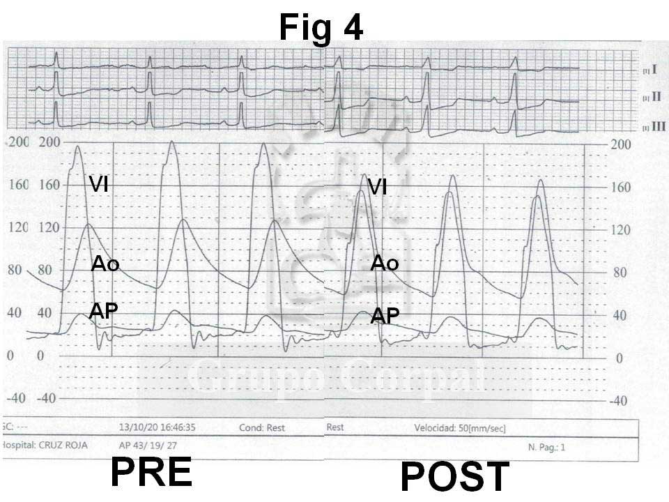 Presiones de ventrículo izquierdo (VI), aorta (Ao) y arteria pulmonar (AP) antes y después del tratamiento