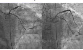 Revascularización precoz en la fase aguda de un infarto de miocardio