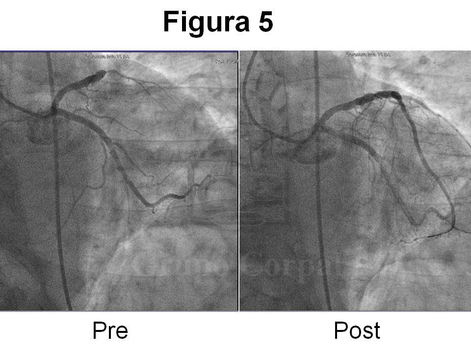 Revascularización precoz en la fase aguda de un infarto de miocardio.  Imágenes comparativas de la coronaria izquierda antes y después del tratamiento. 