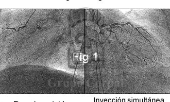 Oclusión coronaria crónica