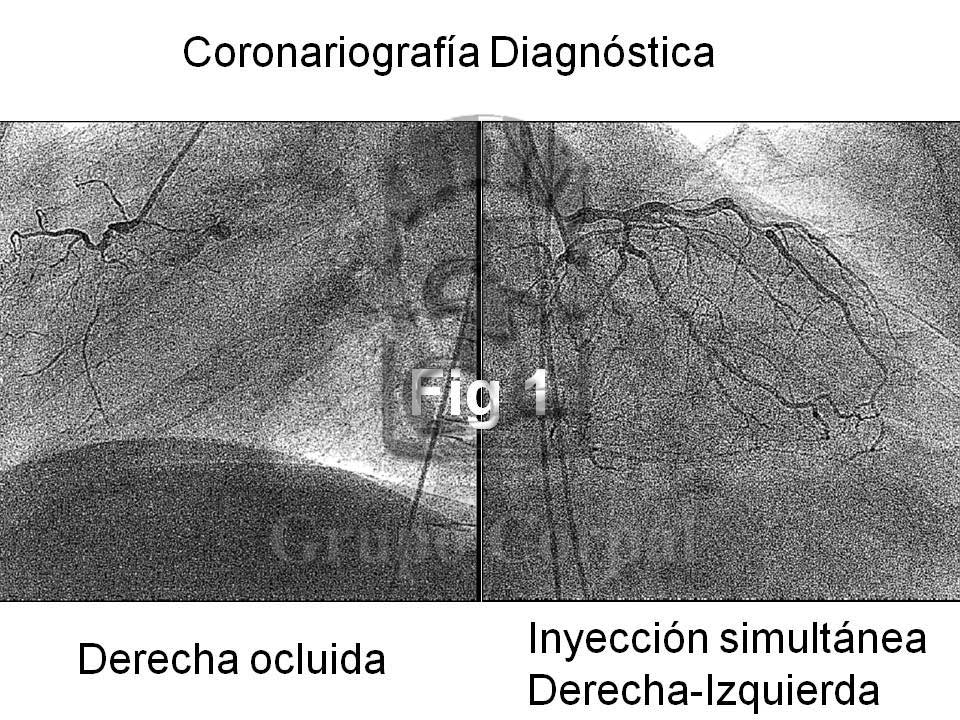 Oclusión coronaria crónica