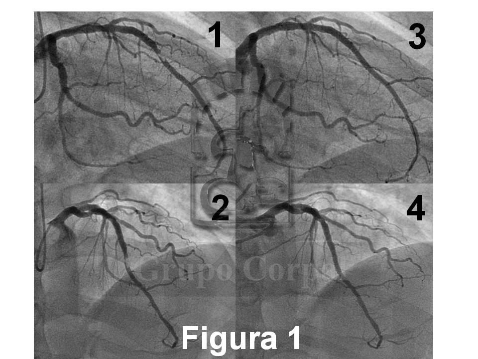 Imágenes angiográficas antes (1 y 2) y después del tratamiento con stent
