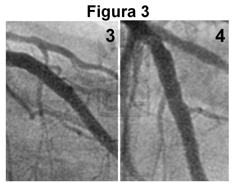 La Figura 3 muestra el resultado angiográfico en las mismas proyecciones (3 y 4).