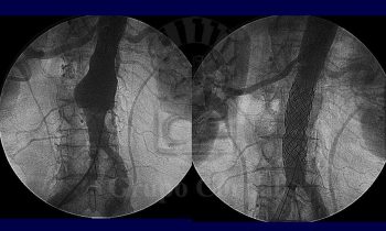 Aneurisma de aorta abdominal infra-renal