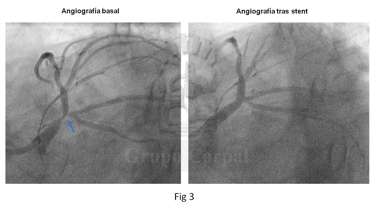 Angiografía basal y tras stent