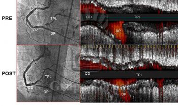 Lesión coronaria en bifurcación tratada con stent