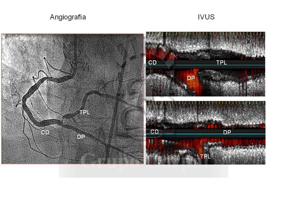 Imágenes de angiografías y ultrasonidos intracoronarias que muestran una lesión severa en coronaria derecha. 