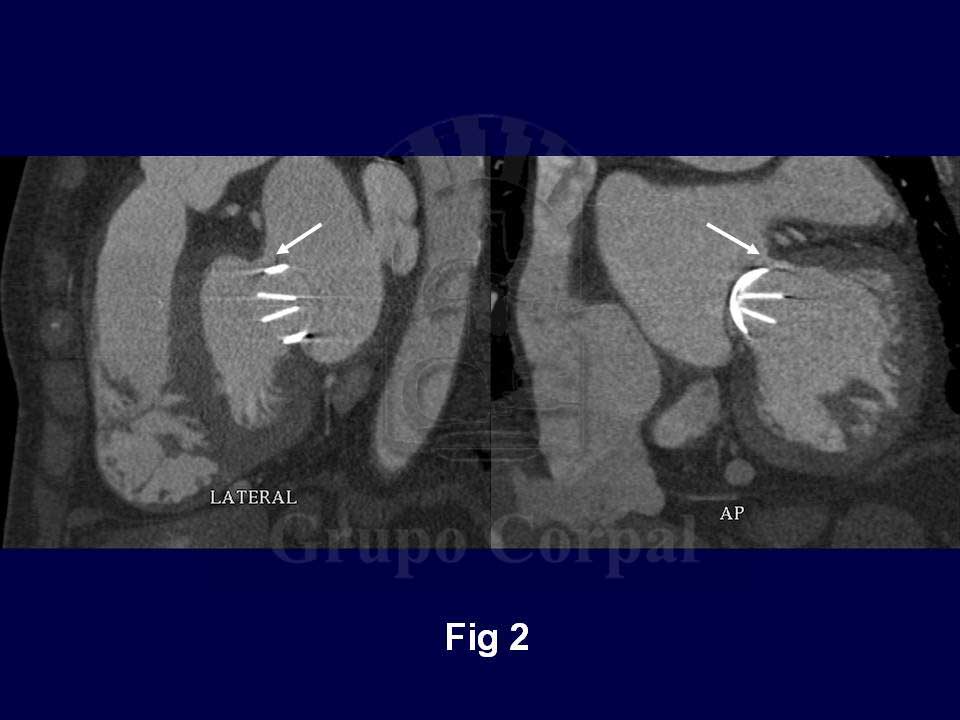 Imágenes TAC-64 en proyección lateral y anteroposterior