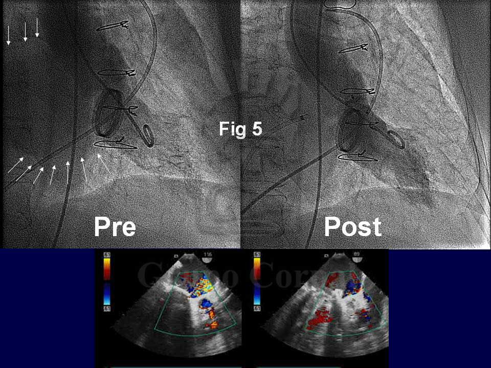 Imágenes angiográficas y ecocardiográficas antes y después del tratamiento