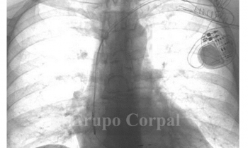 Estimulación cardiaca con sincronía