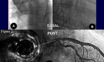 Circulación colateral en la isquemia coronaria aguda